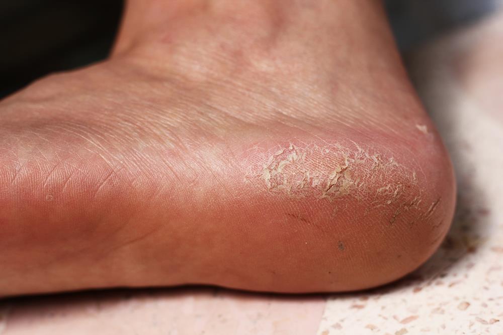 Calluses  Arleta, CA 